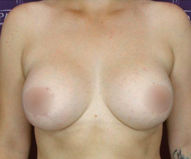 Увеличение груди — Фото после