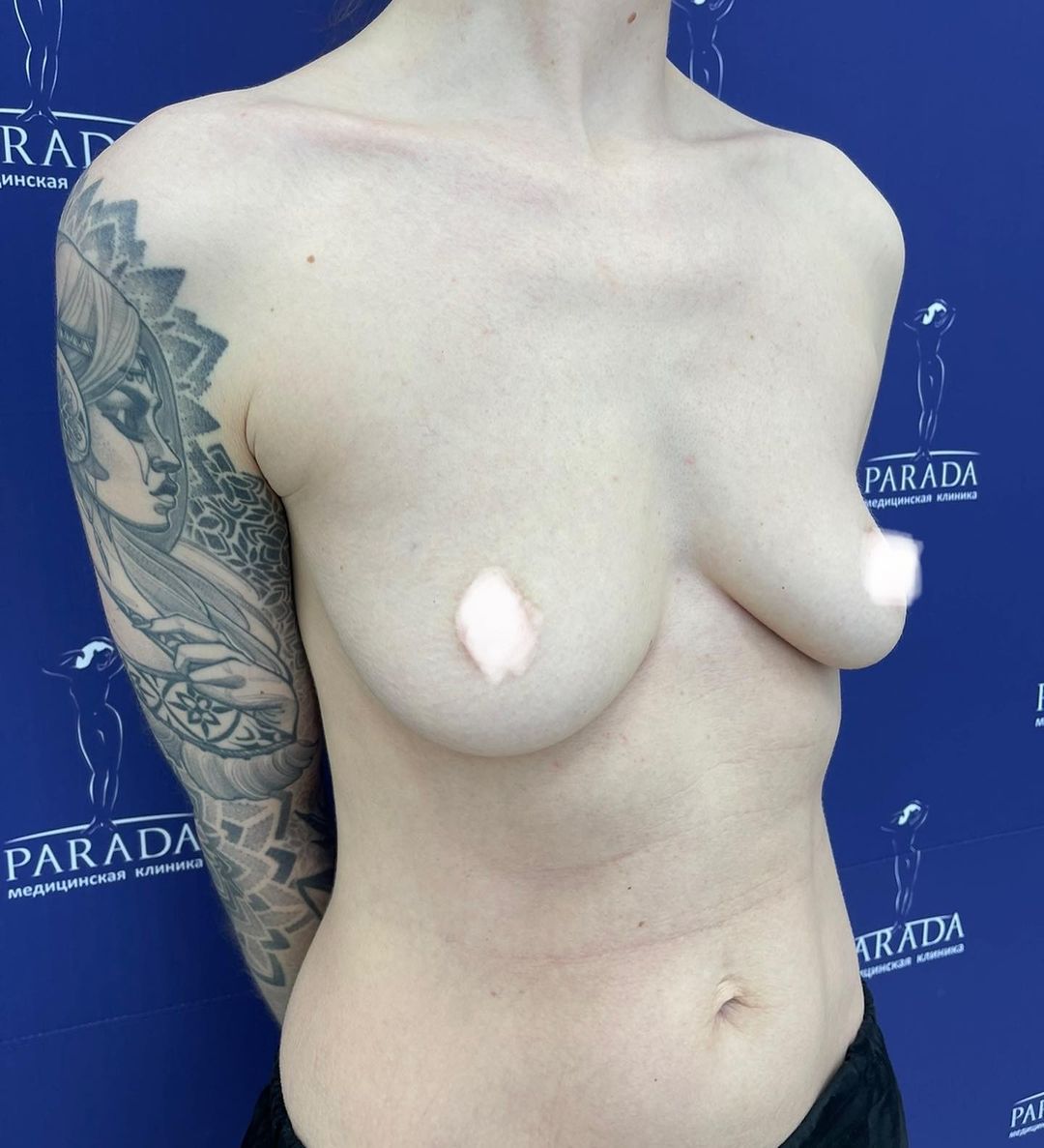 Пластика груди — Фото до