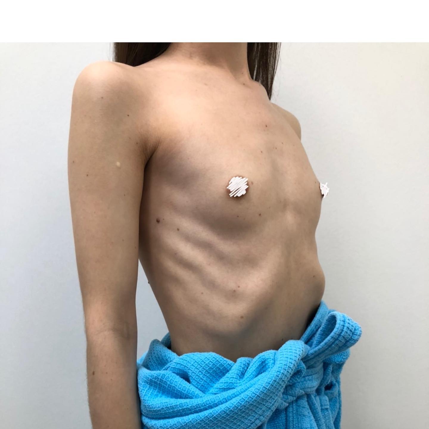 Увеличение груди — Фото до
