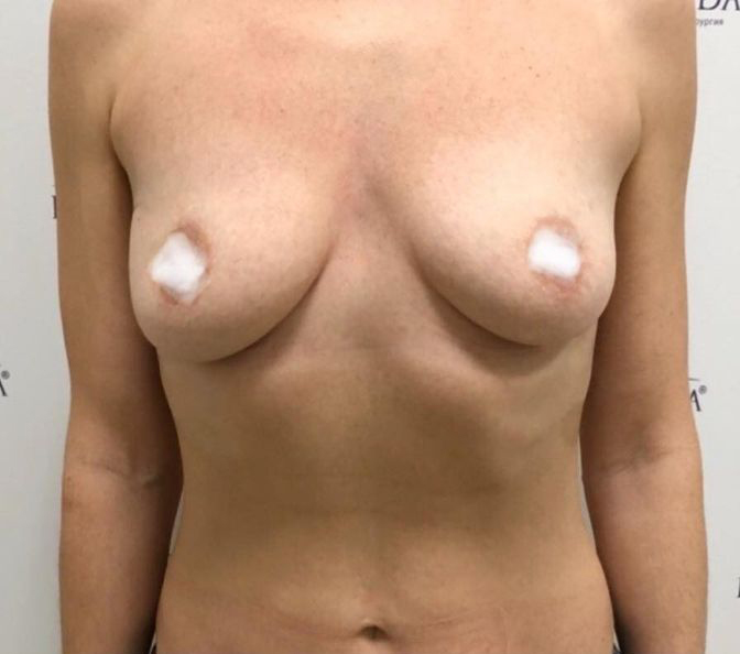 Увеличение груди — Фото до