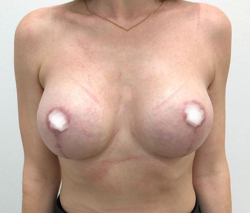 Увеличение груди — Фото после