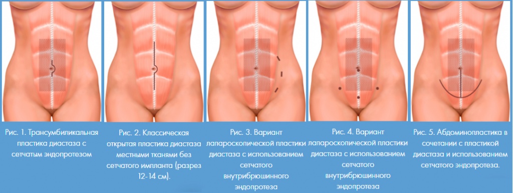 laparoskopicheskaya-.jpg