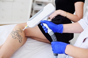 Лазерное удаление татуировок и перманентного татуажа 